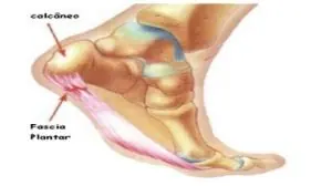 fascite plantar