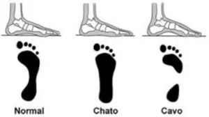 pé normal chato cavo